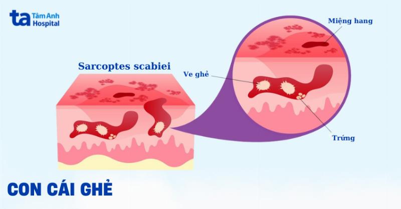 Chó Bị Ghẻ Sarcoptic - Hình ảnh minh họa