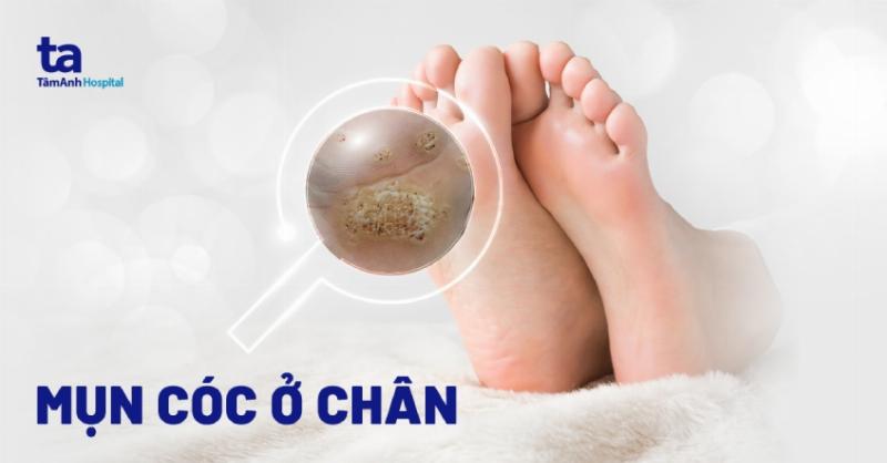 Chó bị nổi mụn thịt: Các triệu chứng thường gặp